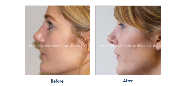 nose reshaping