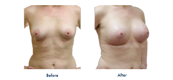 breast augmentation