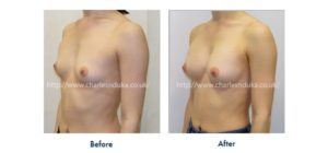 breast augmentation
