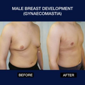 Male Breast reduction