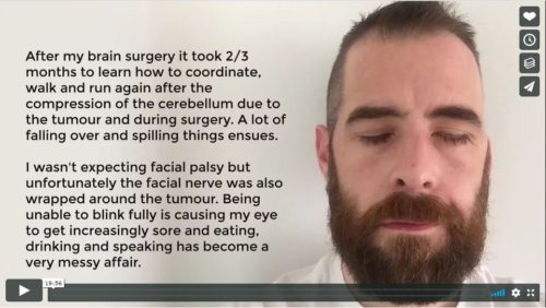Eoin Acoustic Neuroma Facial Palsy Recovery